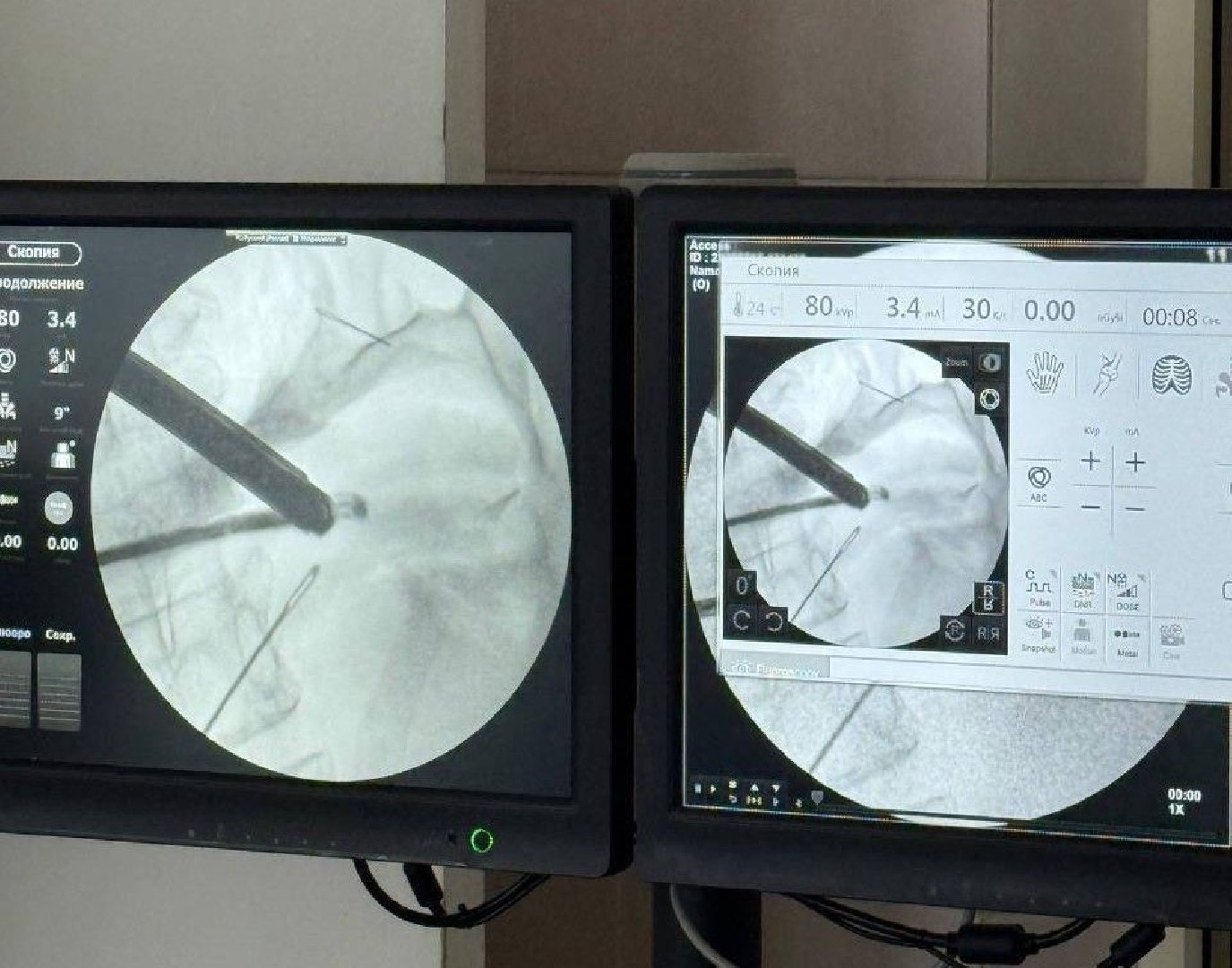 Из живота жительницы Подмосковья извлекли четыре швейные иглы
